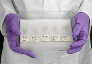 "UNITED KINGDOM - MAY 31:  Samples of lung tissue from T W, case number 51 in Elmes' work with McCaughey and Wade to produce the first detailed UK report of the relationship between exposure to asbestos and the lung cancer mesothelioma. (Photo by SSPL/Getty Images)."