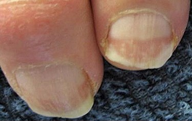 thick-and-dry-toenail